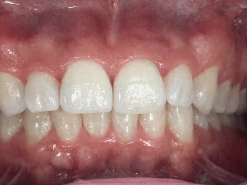 Resultado después del tratamiento dental en Bienestar Dental - Después