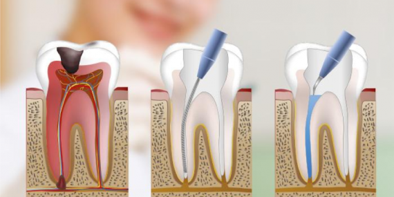 endodoncias y tratamientos de conductos