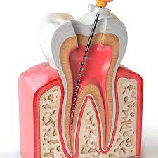 Endodoncia o Tratamientod de Conducto